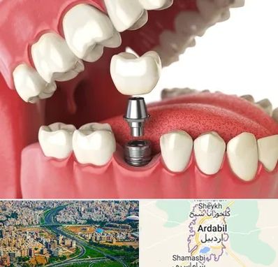 متخصص پروتز دندان در اردبیل