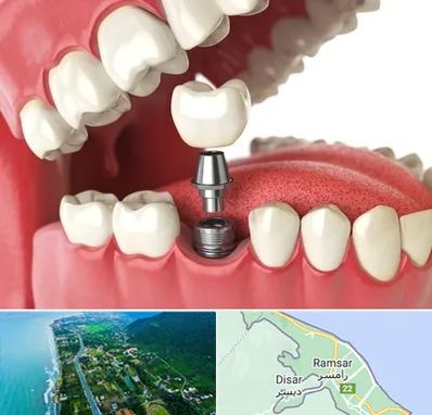 متخصص پروتز دندان در رامسر