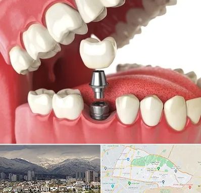 متخصص پروتز دندان در منطقه 4 تهران