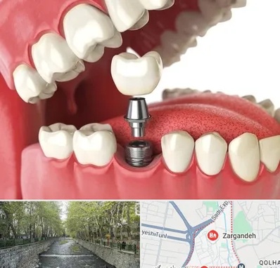 متخصص پروتز دندان در زرگنده