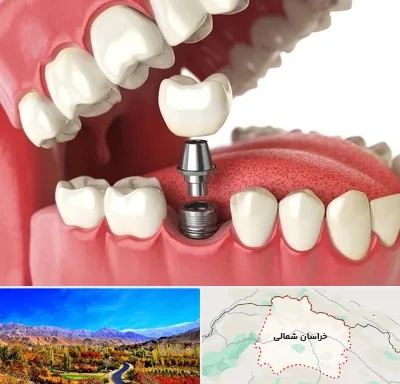 متخصص پروتز دندان در خراسان شمالی