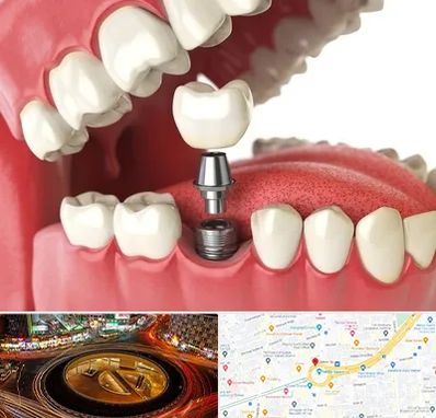 متخصص پروتز دندان در میدان ولیعصر