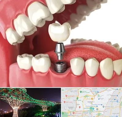 متخصص پروتز دندان در منطقه 3 تهران