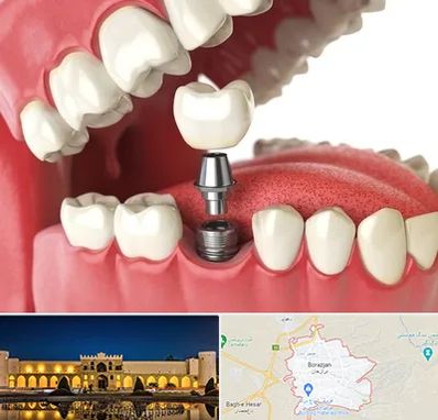 متخصص پروتز دندان در برازجان