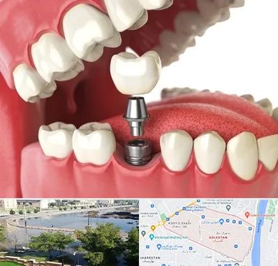 متخصص پروتز دندان در گلستان اهواز
