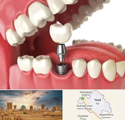 متخصص پروتز دندان در یزد
