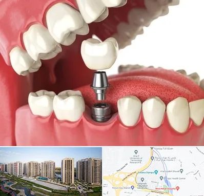 متخصص پروتز دندان در المپیک