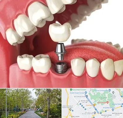 متخصص پروتز دندان در قدوسی غربی شیراز