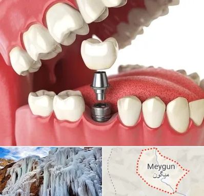متخصص پروتز دندان در میگون