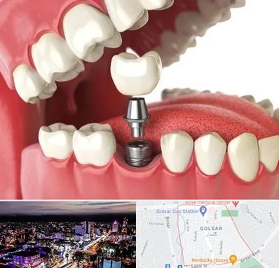 متخصص پروتز دندان در گلسار رشت