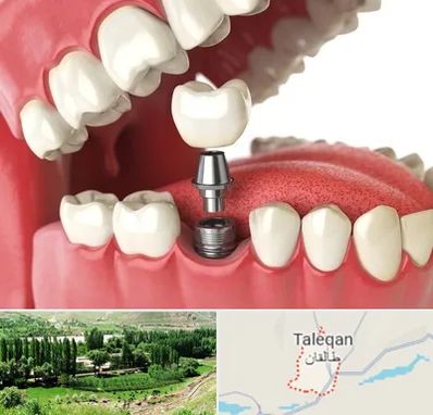 متخصص پروتز دندان در طالقان