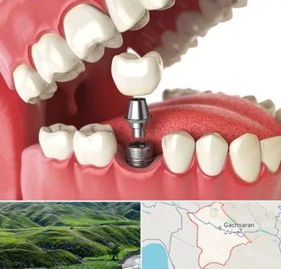 متخصص پروتز دندان در گچساران