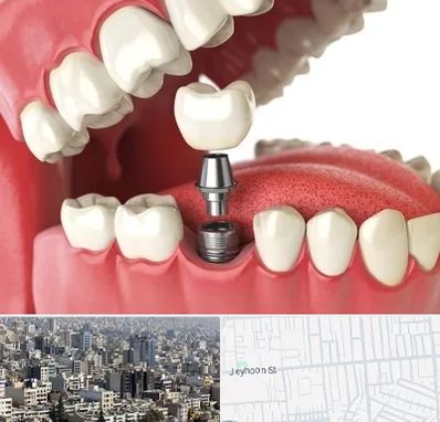 متخصص پروتز دندان در جیحون