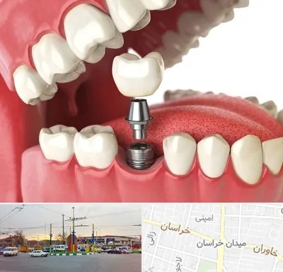 متخصص پروتز دندان در میدان خراسان