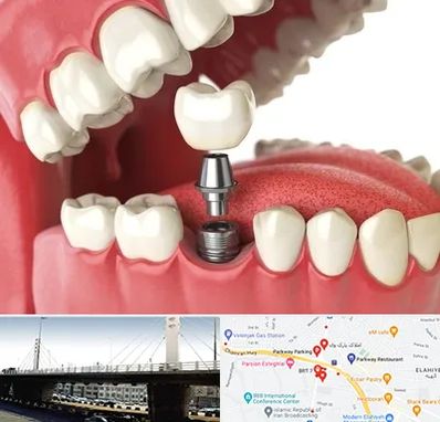 متخصص پروتز دندان در پارک وی