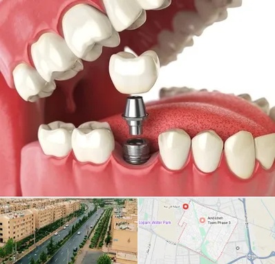 متخصص پروتز دندان در فاز سه اندیشه