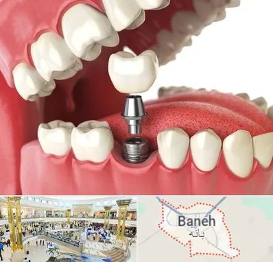 متخصص پروتز دندان در بانه