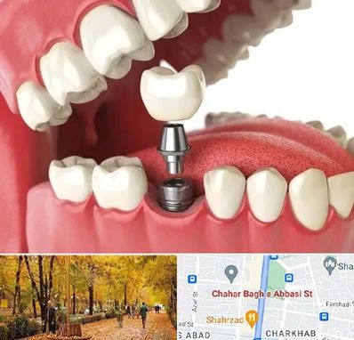 متخصص پروتز دندان در چهارباغ اصفهان