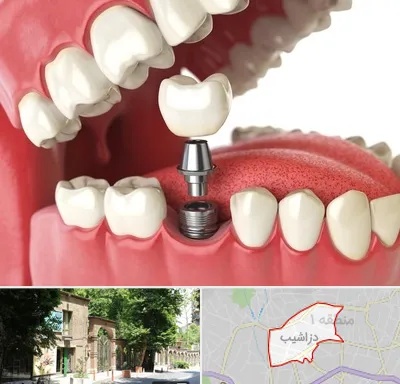 متخصص پروتز دندان در دزاشیب