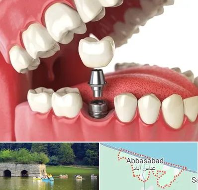 متخصص پروتز دندان در عباس آباد