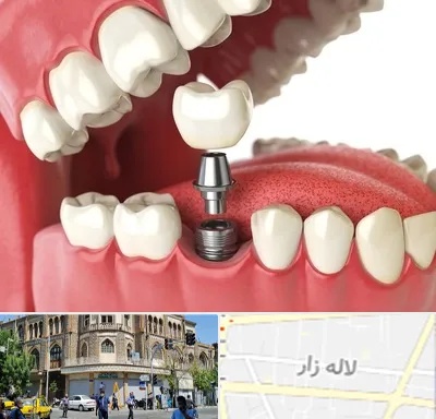 متخصص پروتز دندان در لاله زار