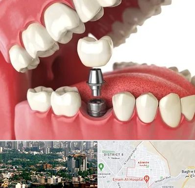 متخصص پروتز دندان در عظیمیه کرج