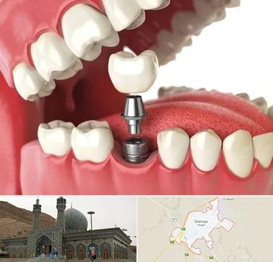 متخصص پروتز دندان در شهرضا