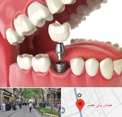 متخصص پروتز دندان در ولیعصر شهریار
