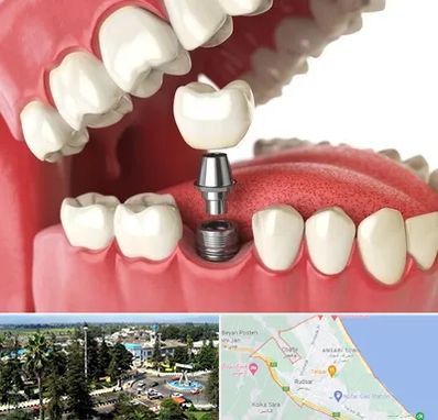 متخصص پروتز دندان در رودسر