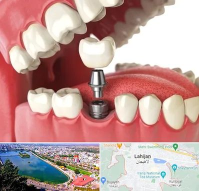 متخصص پروتز دندان در لاهیجان