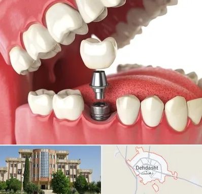 متخصص پروتز دندان در دهدشت