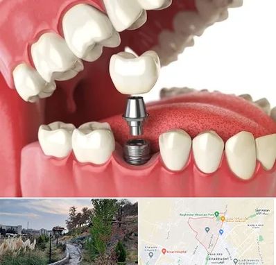 متخصص پروتز دندان در باغستان کرج