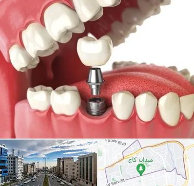 متخصص پروتز دندان در سعادت آباد