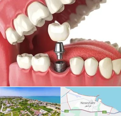 متخصص پروتز دندان در نوشهر