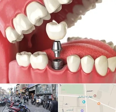 متخصص پروتز دندان در چهارراه استانبول