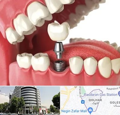 متخصص پروتز دندان در قلهک