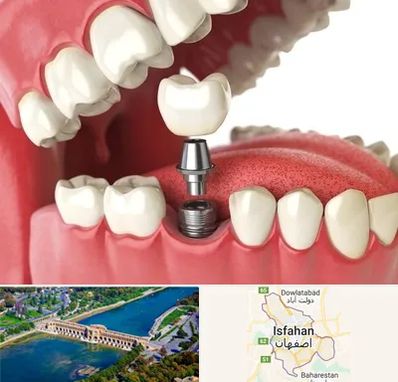 متخصص پروتز دندان در اصفهان