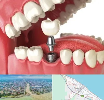 متخصص پروتز دندان در تنکابن