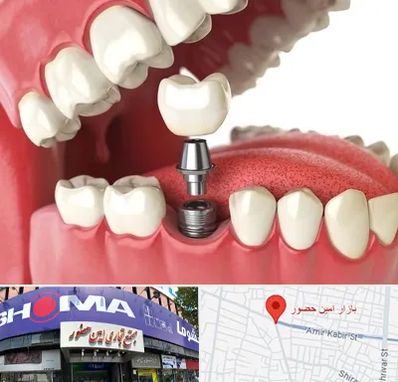 متخصص پروتز دندان در امین حضور