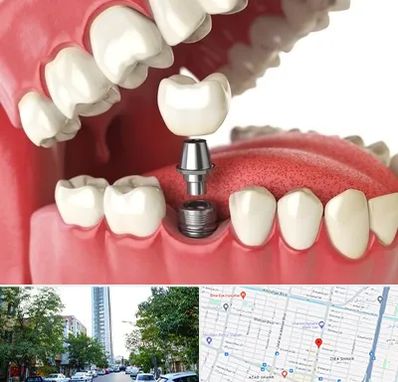 متخصص پروتز دندان در امامت مشهد