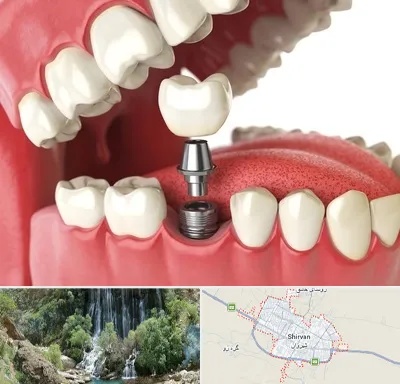 متخصص پروتز دندان در شیروان
