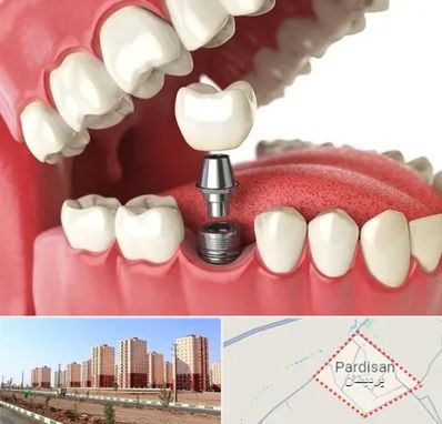 متخصص پروتز دندان در پردیسان قم