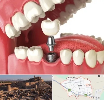 متخصص پروتز دندان در بم