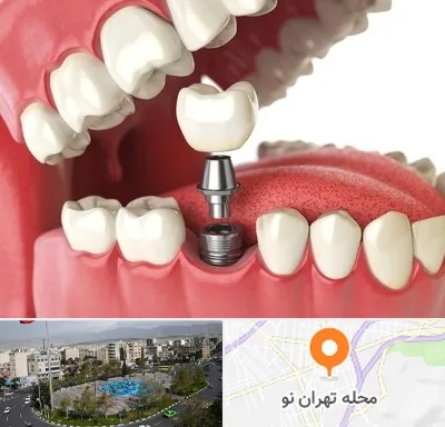 متخصص پروتز دندان در تهران نو
