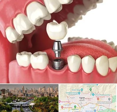 متخصص پروتز دندان در منطقه 1 تهران