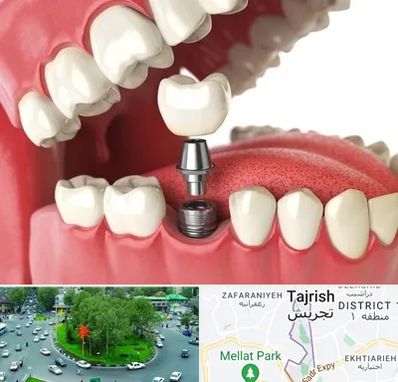 متخصص پروتز دندان در تجریش