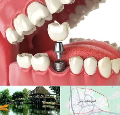 متخصص پروتز دندان در صومعه سرا