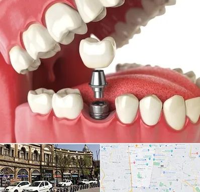 متخصص پروتز دندان در منطقه 11 تهران