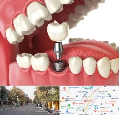 متخصص پروتز دندان در شریعتی