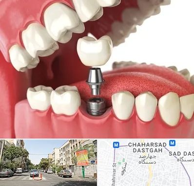 متخصص پروتز دندان در چهارصد دستگاه